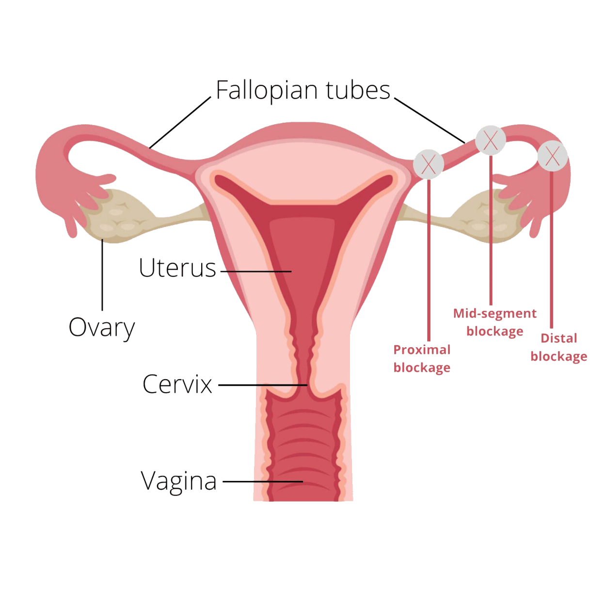 tubal-factor-fallopian-tubes-infertility