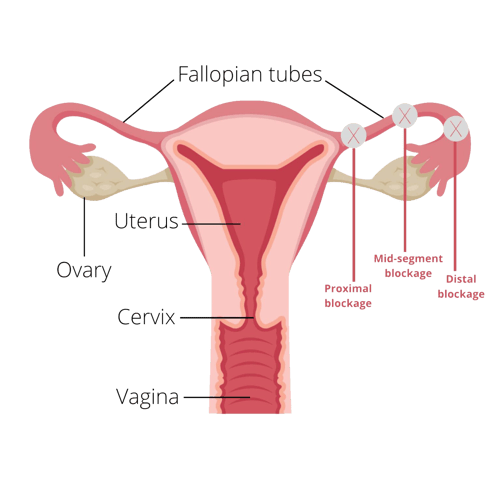 Tubal Factor (Fallopian Tubes) Infertility